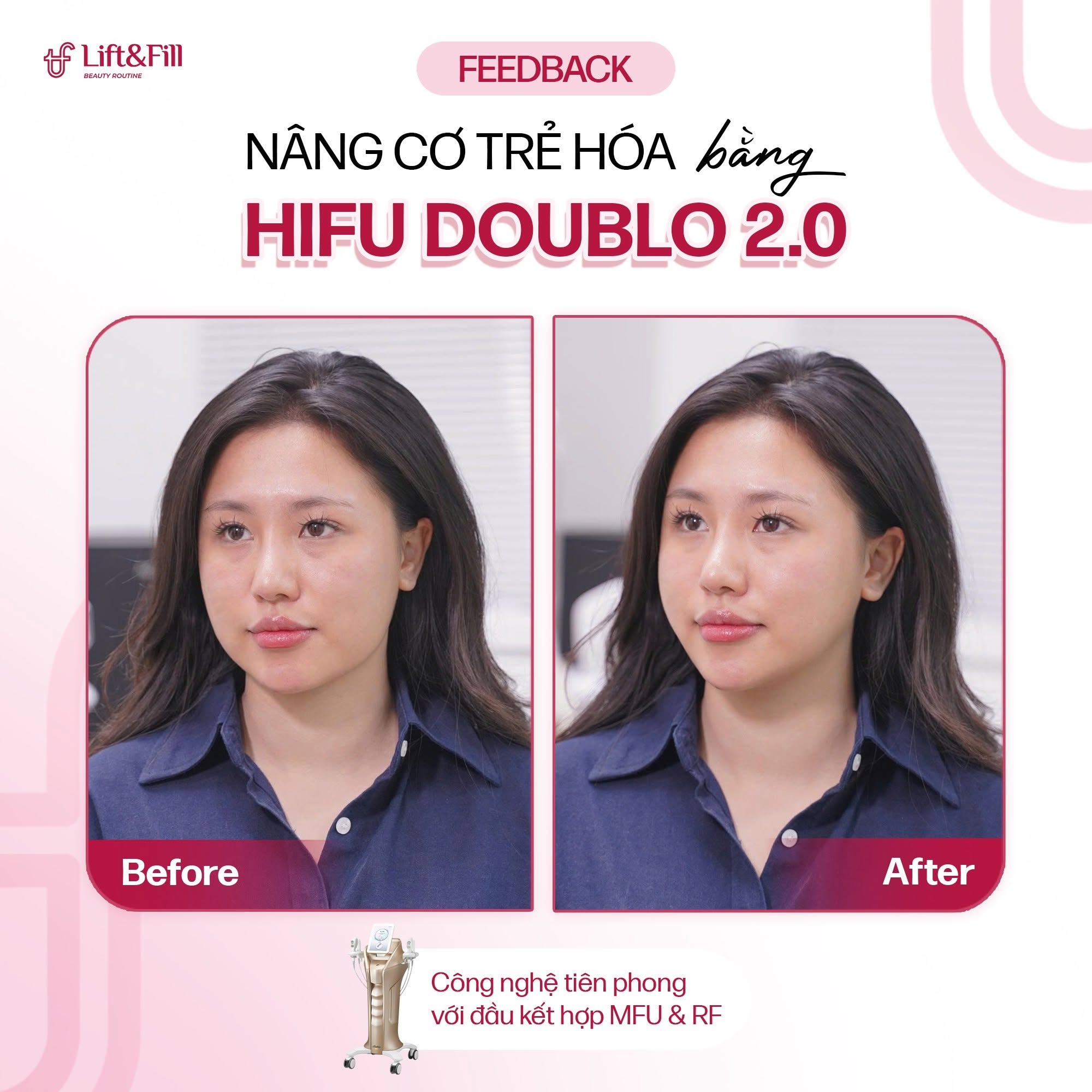 Kết quả trước và sau HIFU Doublo 2.0