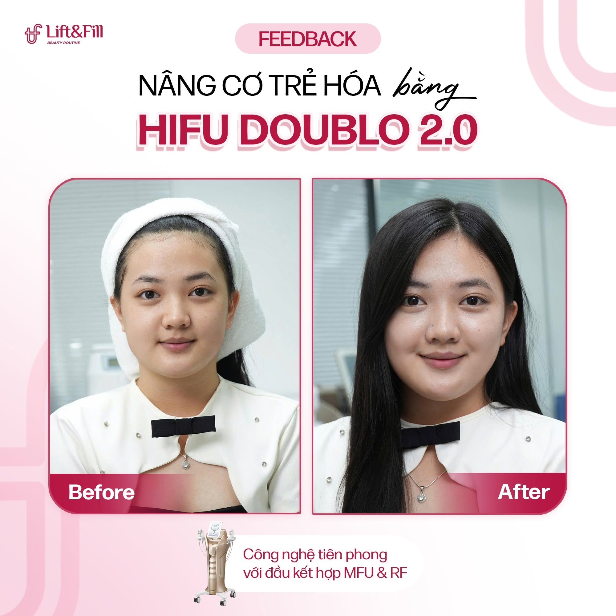 Kết quả trước và sau HIFU Doublo 2.0