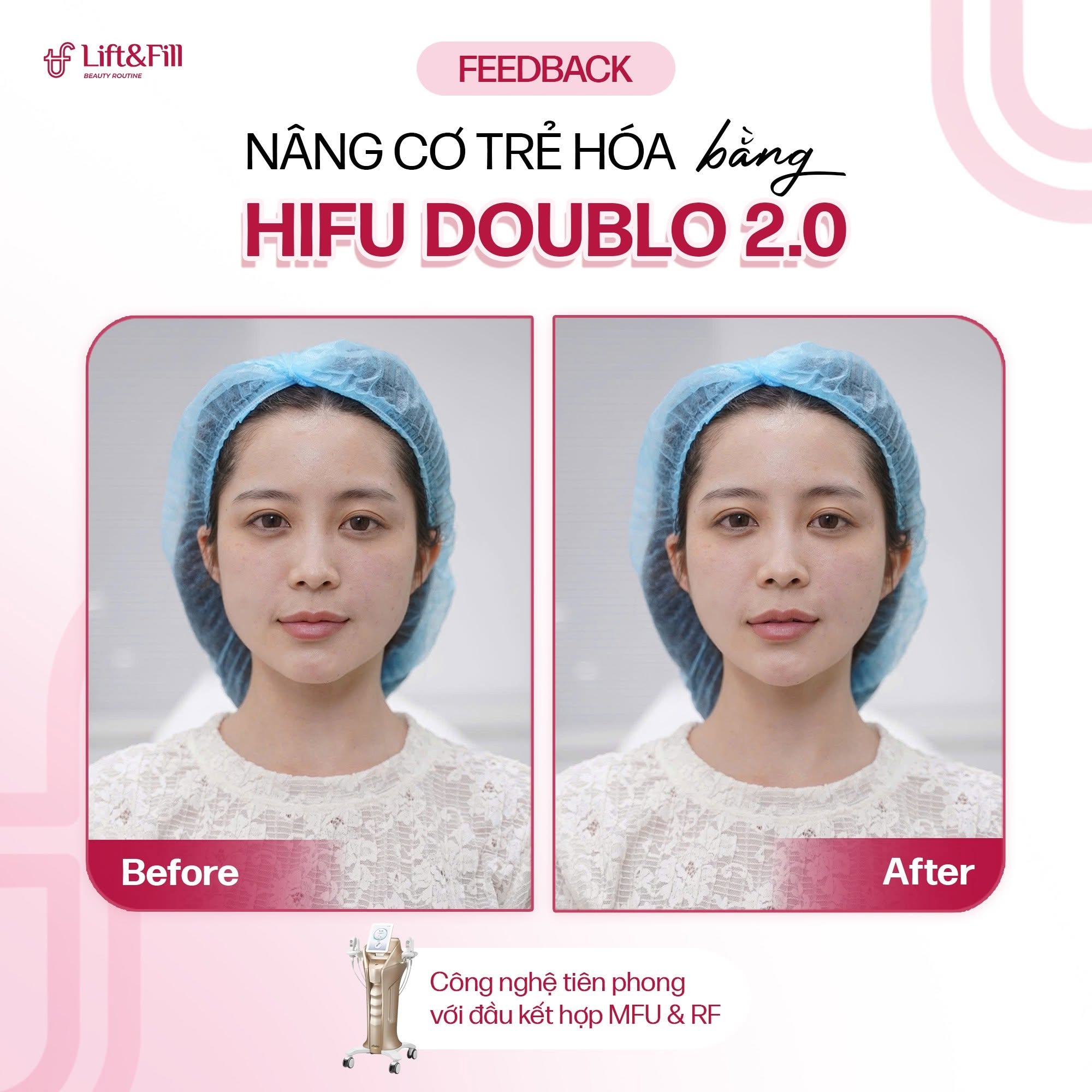 Kết quả trước và sau HIFU Doublo 2.0