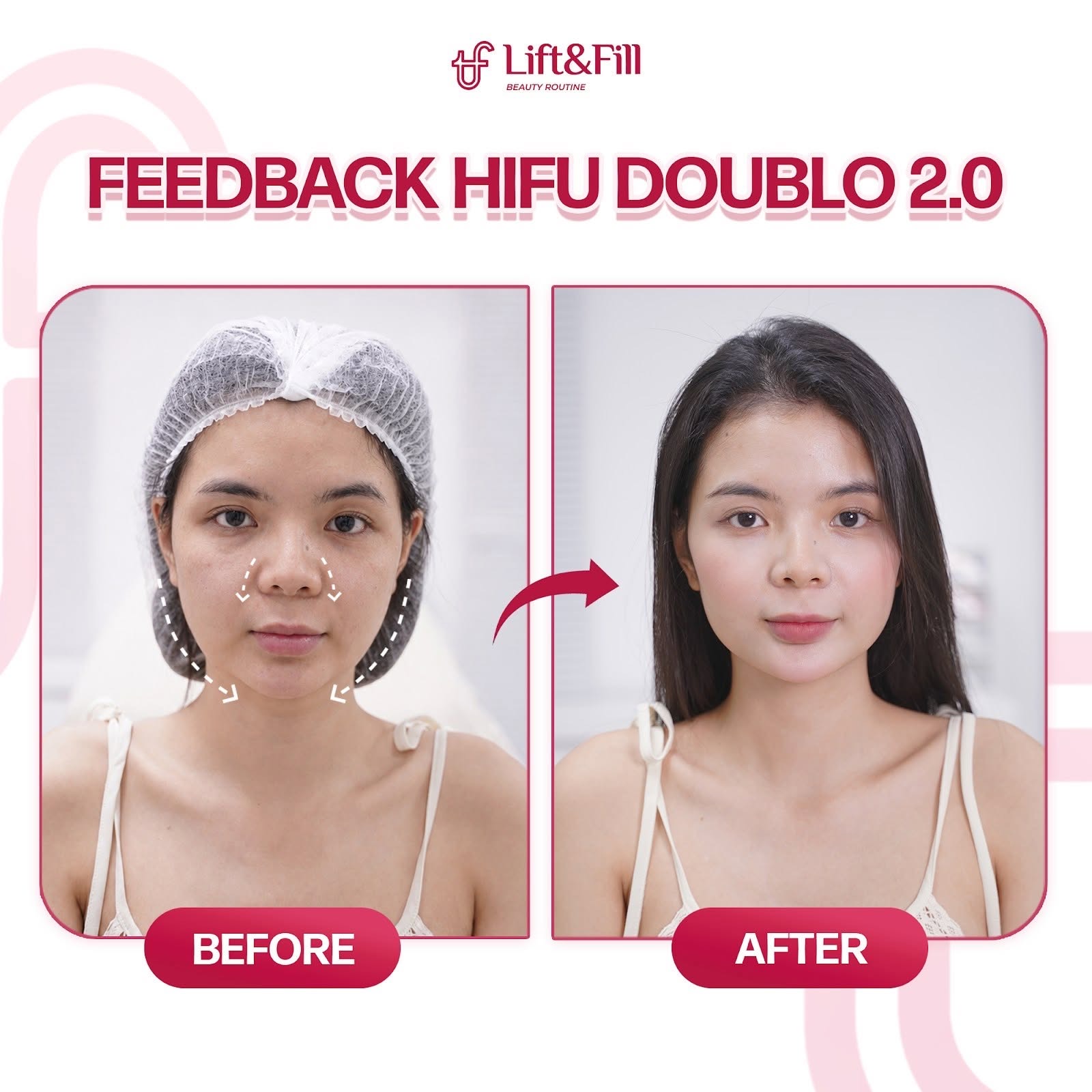 Kết quả trước và sau HIFU Doublo 2.0