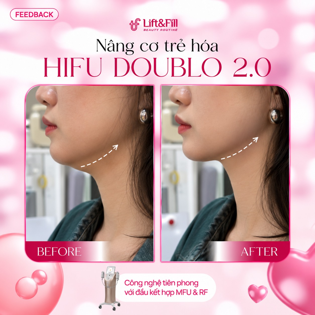 Đường viền hàm trước và sau HIFU Doublo 2.0