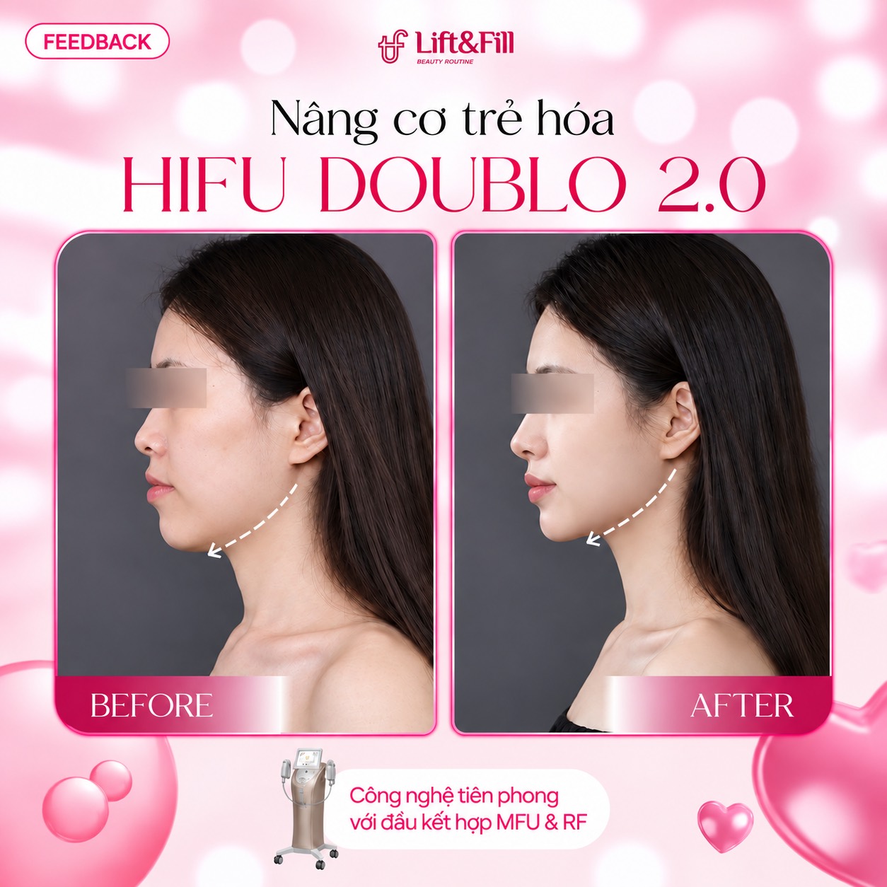 Đường viền hàm trước và sau HIFU Doublo 2.0