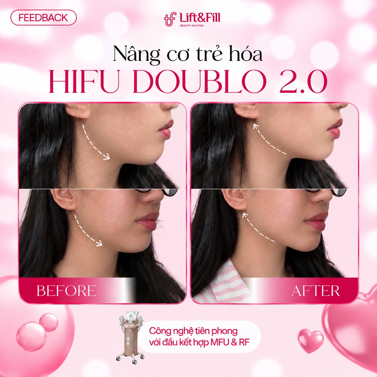Góc nghiêng trước và sau HIFU Doublo 2.0