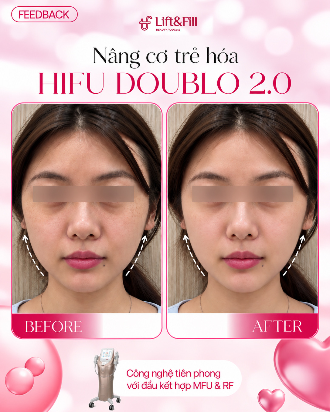 Kết quả trước và sau HIFU Doublo 2.0