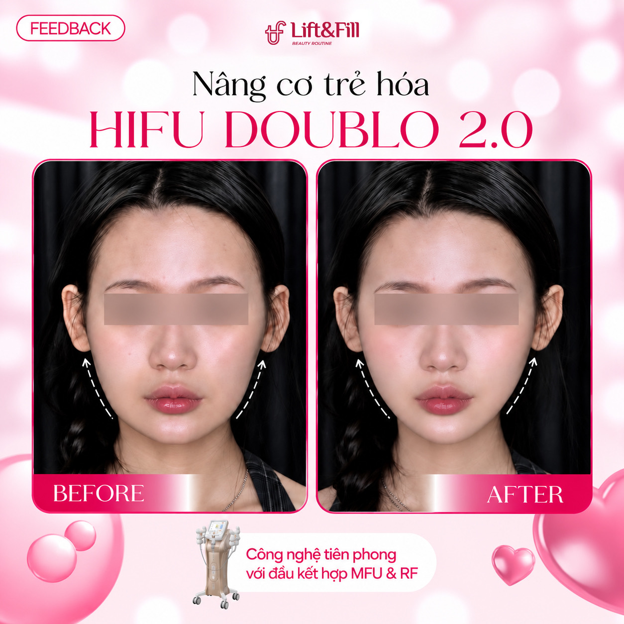 Kết quả trước và sau HIFU Doublo 2.0