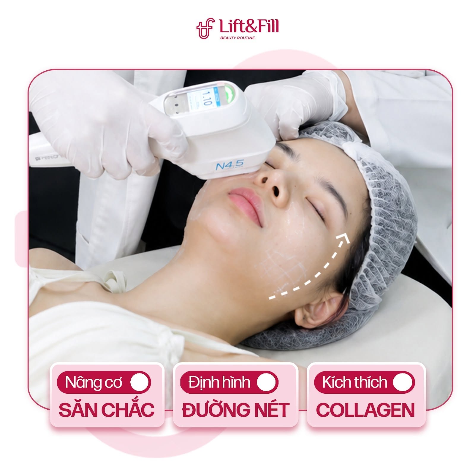 Bác sĩ thực hiện liệu trình HIFU với đầu tuýp N4.5